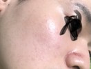 肌の赤みや毛穴の悩みについて