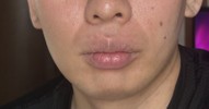 ほうれい線