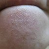 ビニール肌の改善とポツポツ