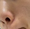 白ニキビ？