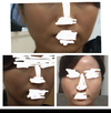 たるみとほうれい線について