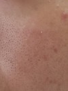 頬に黒いぶつぶつが。毛穴の黒ずみでしょうか？