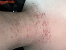 首のボツボツについて