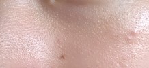 目の下、鼻の下の毛穴について(集合体恐怖症注意)