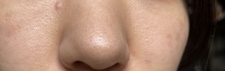 いちご鼻と肌質について