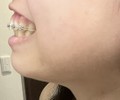 【歯茎写ります】フェイスラインについて