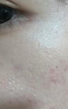 ※肌画像注意 この崩れ方は何が原因でしょうか？