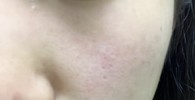 毛穴かクレーターか分からない