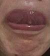 口内炎？粘液嚢胞？病気？