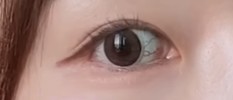 充血と新生血管