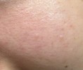 ニキビ？ふきでもの？どうすれば治りますか？