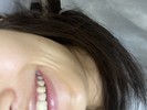 ほうれい線の横にある縦線について