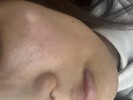 毛穴の種類