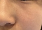 頬の毛穴の開き
