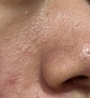 頬の毛穴
