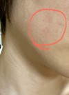 蕁麻疹？ニキビ？かぶれ？