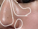 美容皮膚科は学生には高い、、、