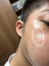 頬にできた透明なブツブツの正体を知りたいです。
