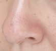 40代鼻の毛穴とカサつき解消したい