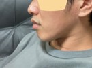 口ゴボとたらこ唇について（唇縮小術について）