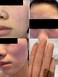 保湿しても治らない顔の皮むけ（3/14日に質問したものです）