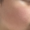 頬の赤みについて
