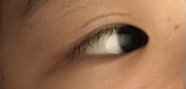 アイプチがうまくいかない
