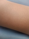 これって毛孔性苔癬なのでしょうか？