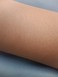 これって毛孔性苔癬なのでしょうか？