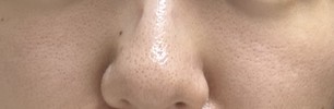 インナードライ肌