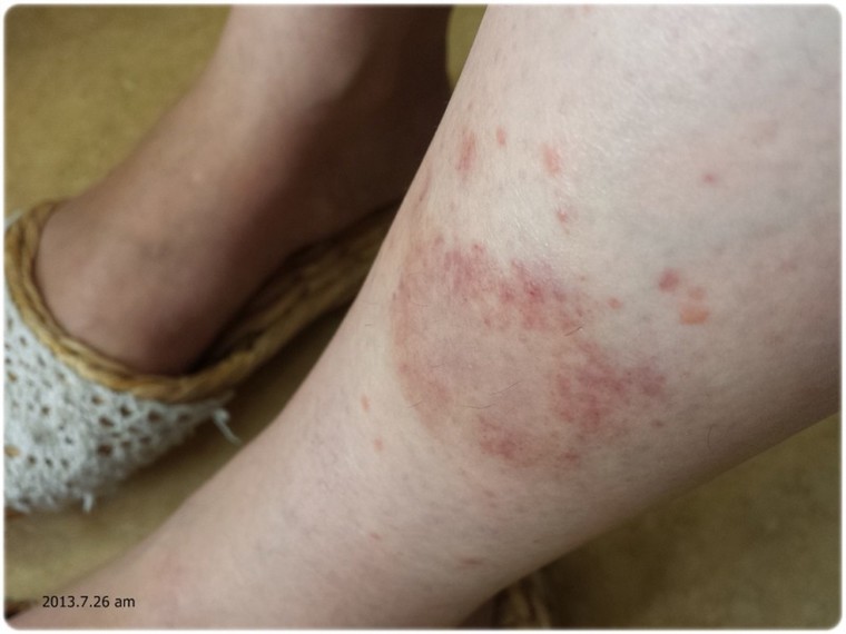 治療記録 自家感作性皮膚炎 2週目 ミワシモさんのブログ Cosme アットコスメ