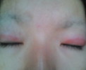 目蓋が腫れてしまって・・・（緊急です）