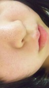 毛穴の黒ずみ