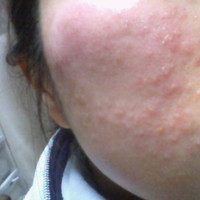 脱ケミ中の肌荒れについて 荒れた肌の写真を載せています Q A Cosme アットコスメ