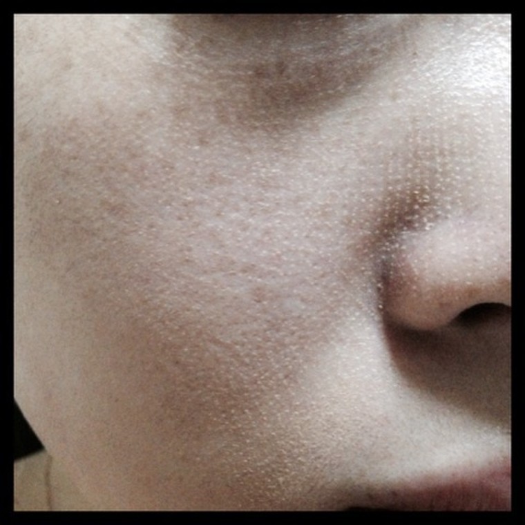 美容皮膚科 Co2フラクショナルレーザー 施術後の化粧のり Rinrinringo713さんのブログ Cosme アットコスメ