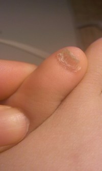 両足の小指の爪が変形 ここ半年ぐらい 足の小指の爪が変形 Q A Cosme アットコスメ