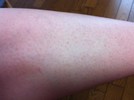 足の毛穴の赤いぷつぷつについて