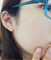 酷いニキビとニキビ跡を治したい！