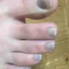 変色した足の爪。何かの病気でしょうか？