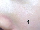 頬の凸凹について&鼻の赤み、黒っぽい毛穴、白いうようよについて