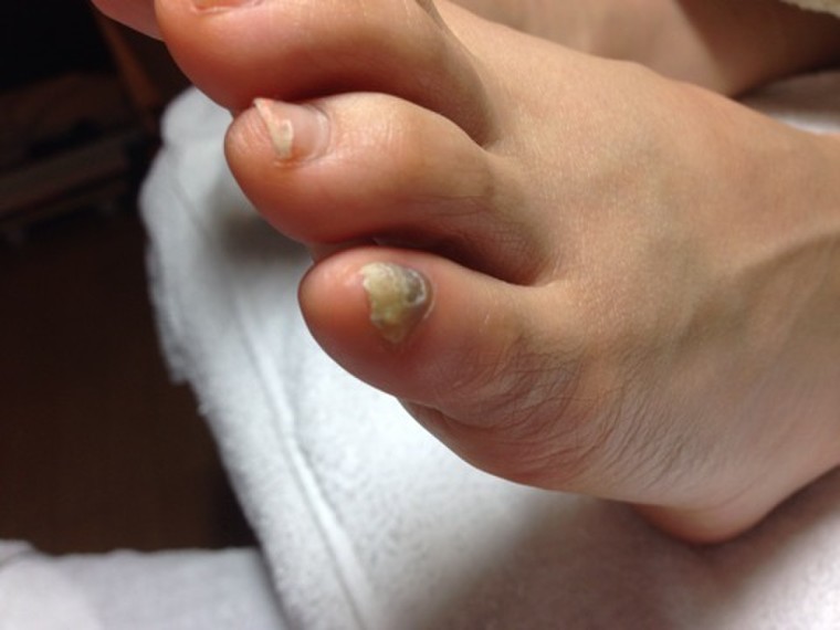 足の小指の爪が割れてきて引っかかる サトケイさんのブログ Cosme アットコスメ