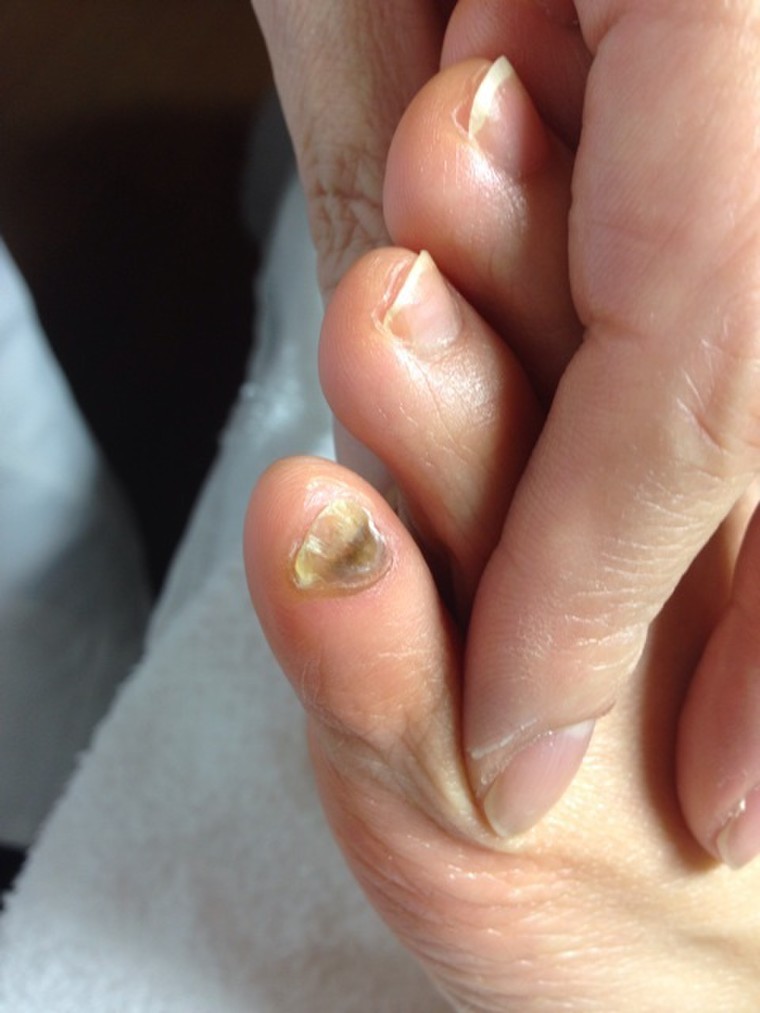 足の小指の爪が割れてきて引っかかる サトケイさんのブログ Cosme アットコスメ