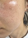 毛穴の種類を教えてください