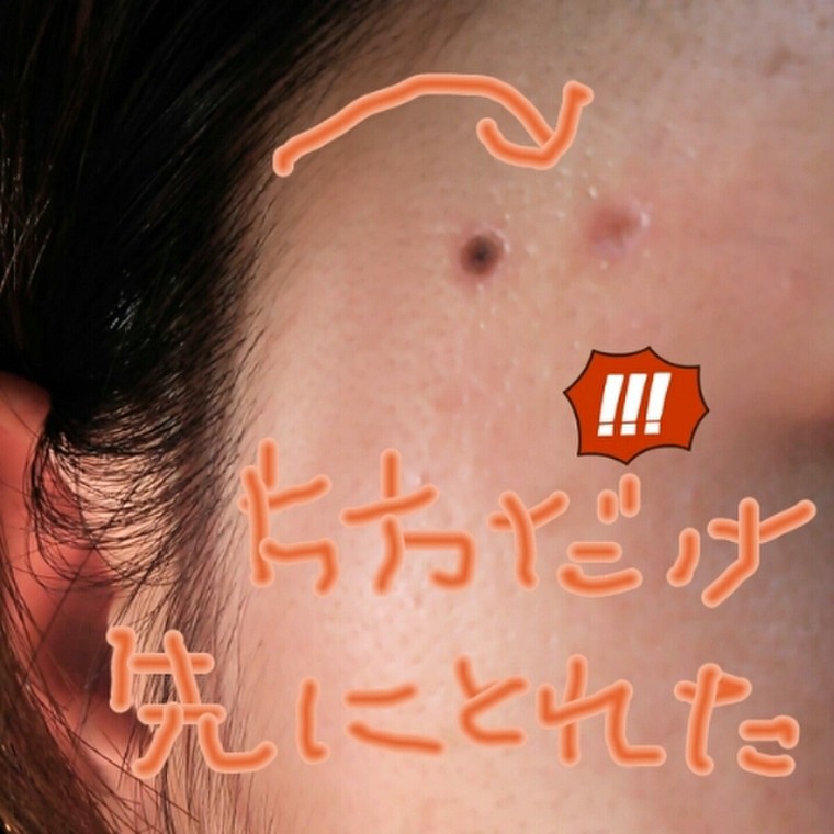 ほくろ片方とれたー ミケ0929さんのブログ Cosme アットコスメ ほくろ片方とれたー ミケ0929さんのブログ Cosme アットコスメ