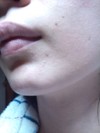 (※長文です)肌測定で油分が少ないのに、皮膚科医から見ると脂性肌？