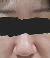 この毛穴は何タイプなのでしょうか？
