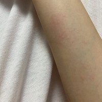 腕の湿疹 写真ではわかりづらいのですが 急に両腕の内側が Q A Cosme アットコスメ