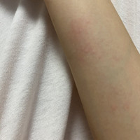 腕の湿疹 写真ではわかりづらいのですが 急に両腕の内側が Q A Cosme アットコスメ 腕の湿疹 写真ではわかりづらいのですが 急に両腕の内側が Q A Cosme アットコスメ