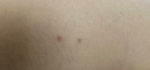 虫刺され跡が消えない
