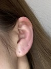 耳が腫れてきた